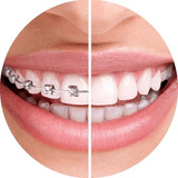Boca De Aparelho / Braquetes Ortodônticos Metal (promoção)