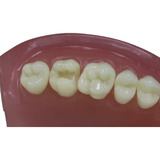 Dente Pronew 17 Dentistica