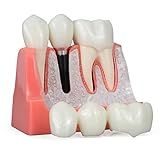 ANNWAH Modelo De Implante Dentário Annwan 4 Vezes Modelo De Dentes De Demonstração De Ponte De Coroa De Análise Removível Para Educação De Classe E Estudo De Modelo De Dentes