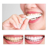 Facetas Removíveis Superior E Inferior Snap On Smile par 